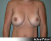 Breast Augmentation Patient