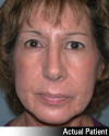 Brow Lift Patient