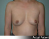 Breast Augmentation Patient