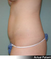 Tummy Tuck Patient