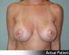 Breast Lift and Augmentation Patient