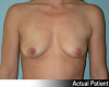 Breast Augmentation Patient