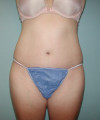 Tummy Tuck Patient