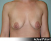 Breast Augmentation Patient