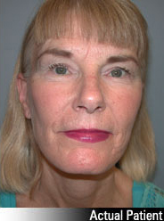 Patient # 20692 After Photo # 2