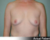 Breast Augmentation Patient