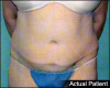 Tummy Tuck Patient