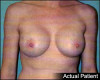 Breast Augmentation Patient