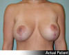 Breast Lift and Augmentation Patient