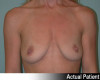 Breast Augmentation Patient