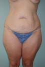 Tummy Tuck Patient