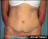 Tummy Tuck Patient