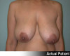 Breast Reduction Patient