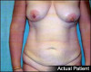 Tummy Tuck Patient