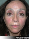 Brow Lift Patient