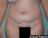 Tummy Tuck Patient