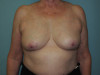 Breast Reduction Patient