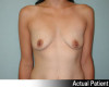 Breast Augmentation Patient