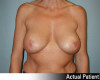 Breast Augmentation Patient