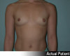 Breast Augmentation Patient