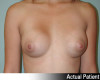 Breast Augmentation Patient