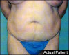 Tummy Tuck Patient