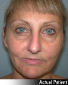 Eyelid Lift - Blepharoplasty Patient