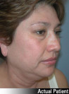 Face Lift and Neck Lift Patient