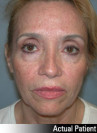 Eyelid Lift - Blepharoplasty Patient