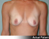 Breast Augmentation Patient