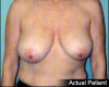 Breast Reduction Patient