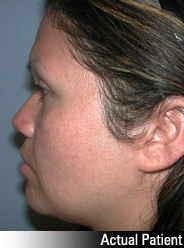 Patient # 41896 Before Photo # 3