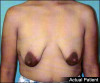 Breast Lift and Augmentation Patient