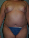 Tummy Tuck Patient