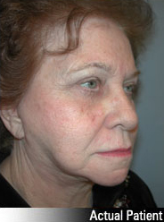 Patient # 49634 After Photo # 4