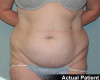 Tummy Tuck Patient