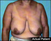 Breast Lift Patient