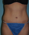 Tummy Tuck Patient