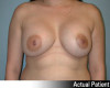 Breast Augmentation Patient