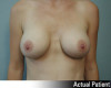 Breast Augmentation Patient