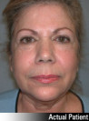 Facelift Patient