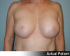 Breast Augmentation Patient