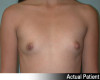 Breast Augmentation Patient