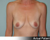 Breast Augmentation Patient