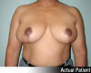 Breast Reduction Patient