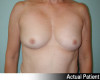 Breast Augmentation Patient