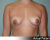 Breast Augmentation Patient