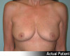 Breast Augmentation Patient