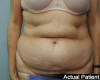 Tummy Tuck Patient