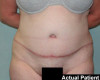 Tummy Tuck Patient